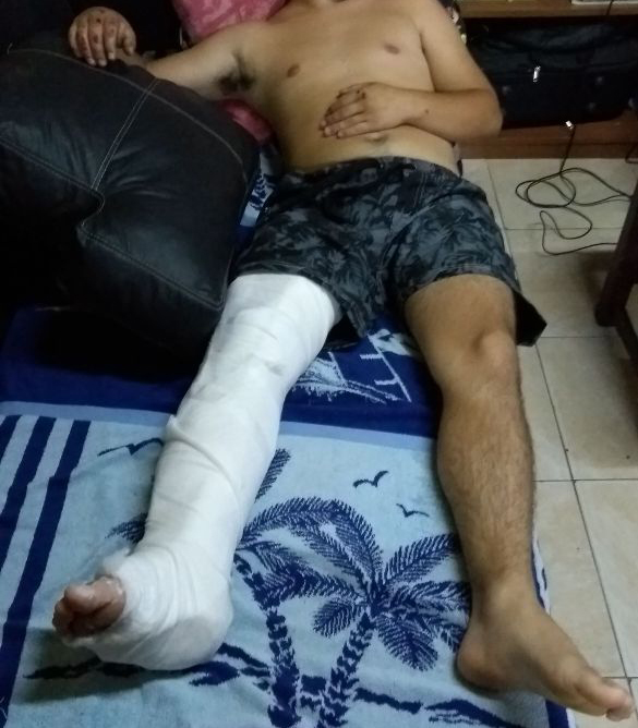 La pierna quebrada del joven que espera en su casa a que lo operen