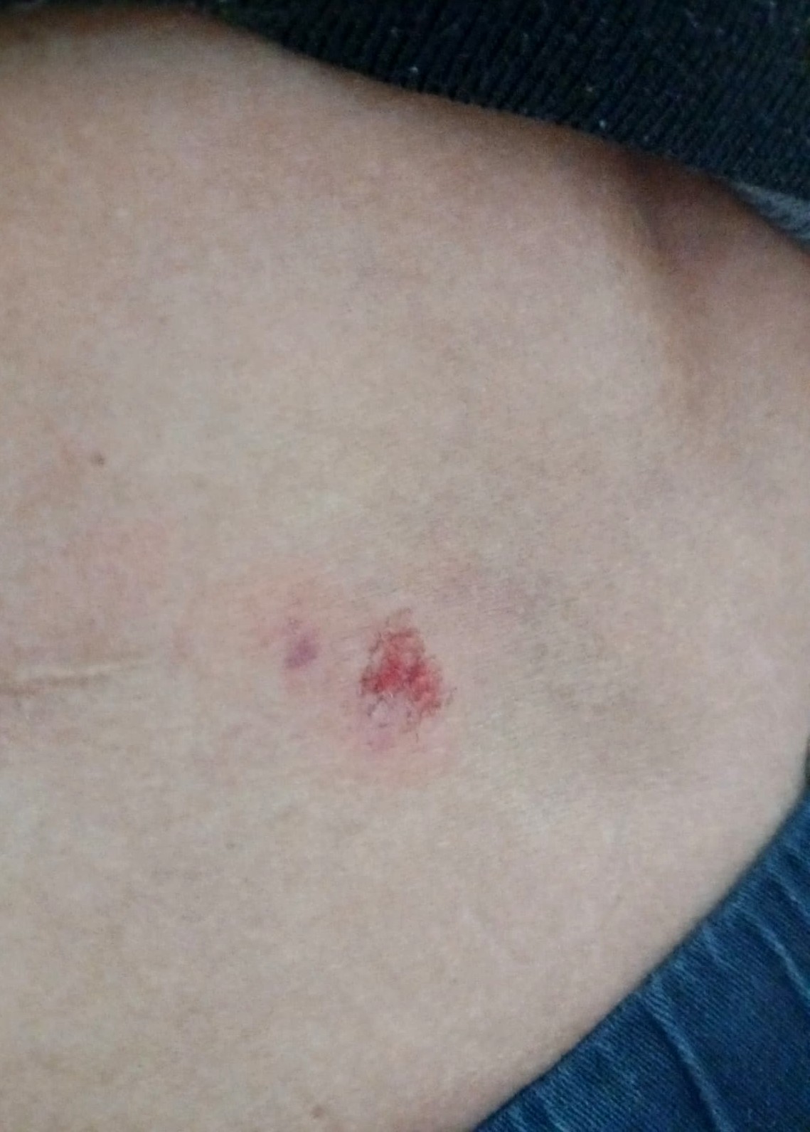 Uno de los jugadores que recibió un golpe con un cascote mostró las marcas que le quedaron