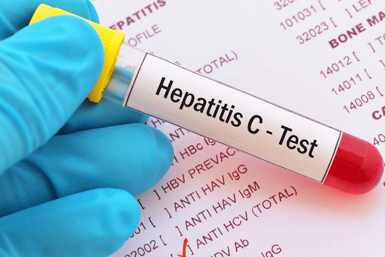 Hepatitis C: testeos rápidos para detectar una enfermedad que puede permanecer silenciosa durante décadas - Noticias -